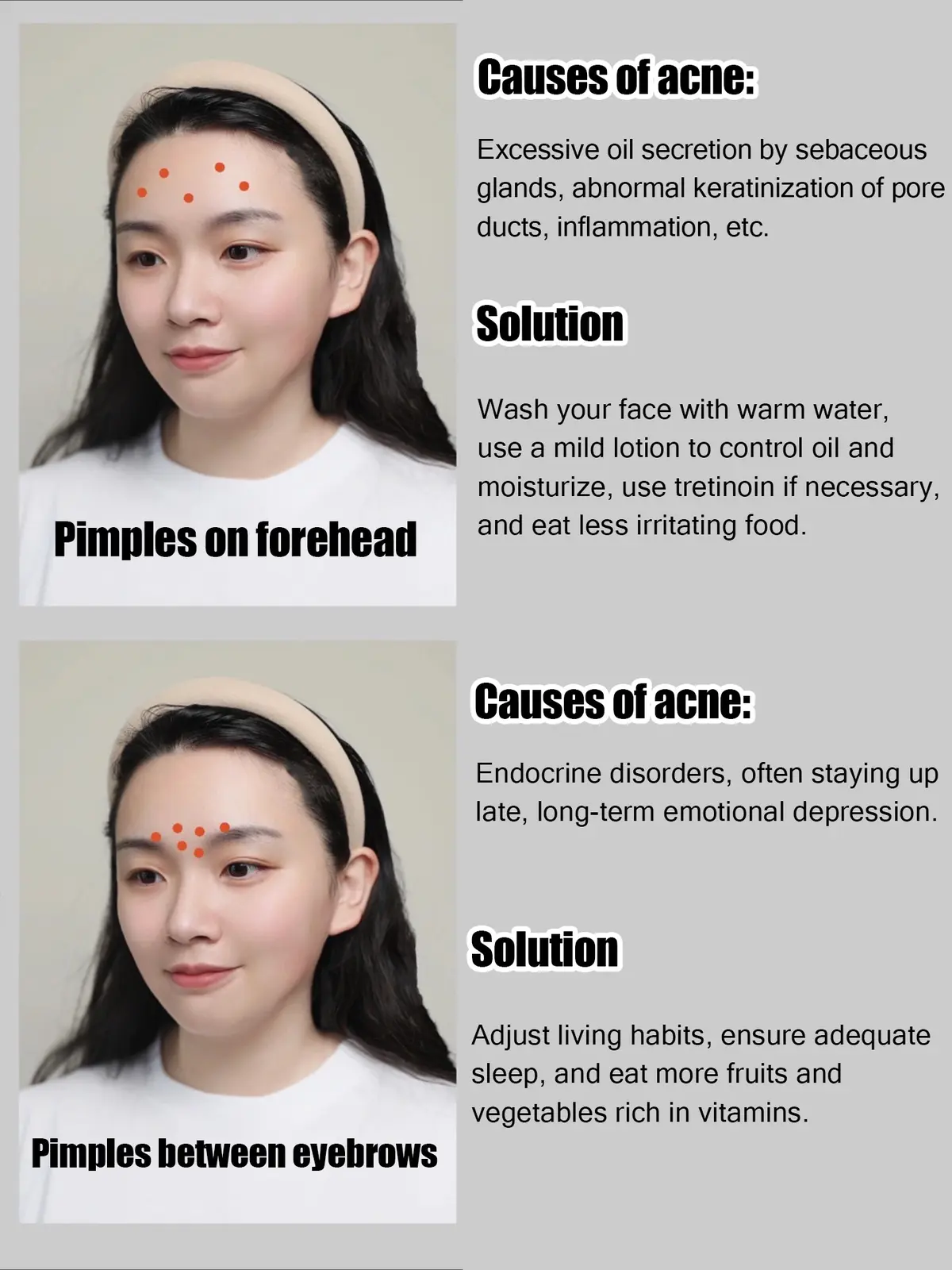 ateş Manav Göç  🌼🌼 Skincare routine when you have acne🌼🌼 | Gallery posted by A.G.N.E.S.  | Lemon8